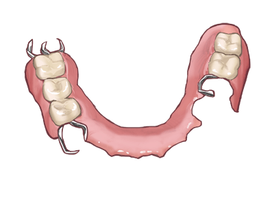 部分入れ歯