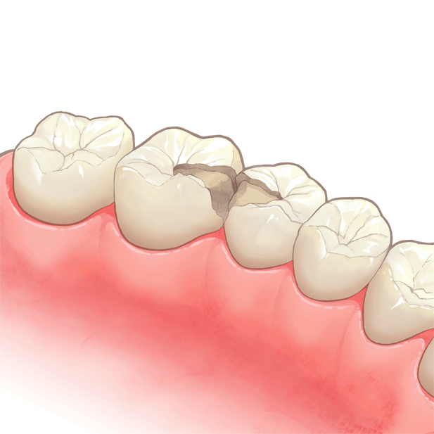 虫歯治療