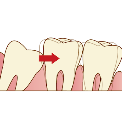 親知らずの治療