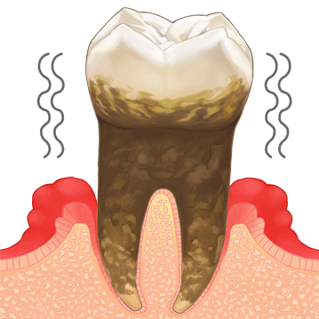 歯周病治療